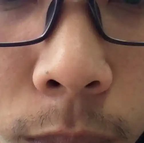 这算是朝天鼻吗