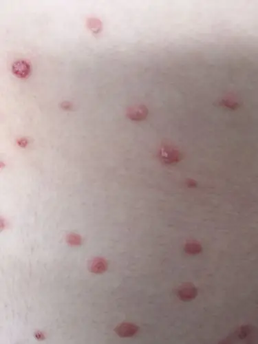 急性点滴型银屑病的元凶原来是你