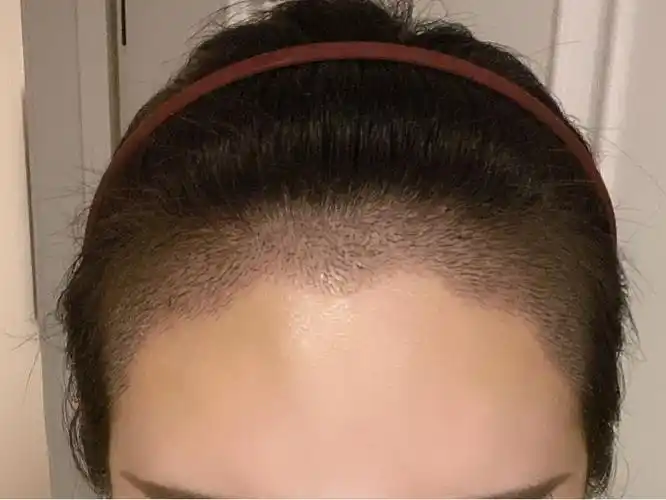 波浪形,心型,直线形,锯齿形心形发际线的标配是美人尖,这种发际线一般