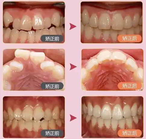 矫正前后对比.jpg