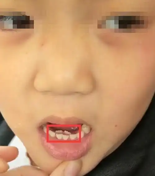 六岁男孩长出"双排牙",需要一颗颗拔掉,奶奶自责不已,都赖我