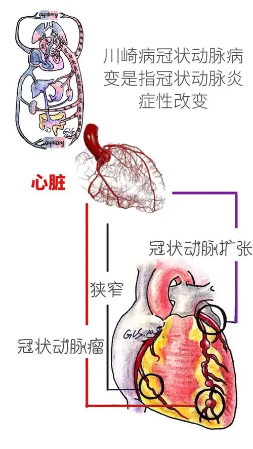 冠状动脉瘤的4种结局所有川崎病患儿均应终生注意导致动脉粥样硬化的