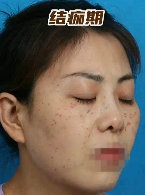 激光祛斑三天后的照片真人祛斑果对比肌肤洁白无瑕