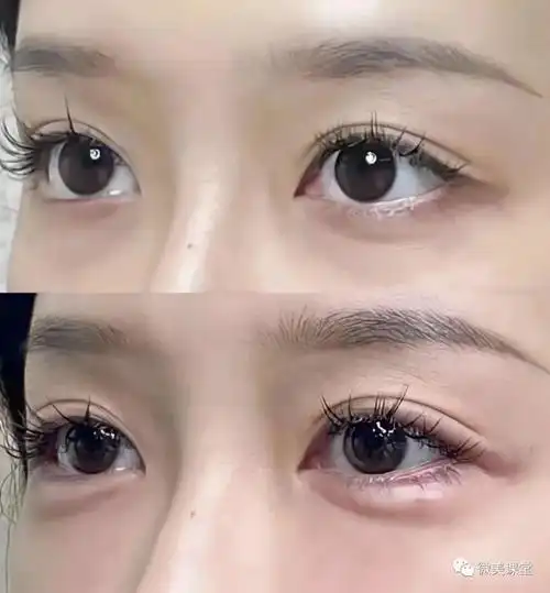 玻尿酸注射卧蚕操作方法及注意事项大全 真,假性眼袋的处理