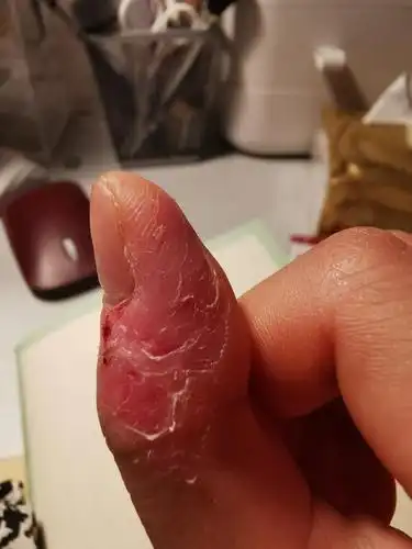 最近太焦虑了,常年被撕烂的右手手指,又烂了