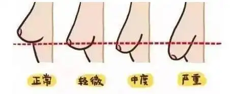 乳房下垂如何修复 不同程度的下垂对应解决方式是什么?