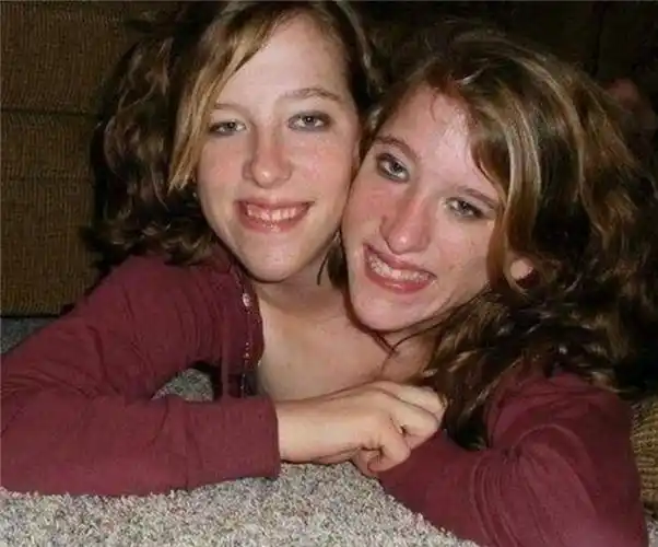 "双头人"就是共用全身,比正常人多出了一个头.双头连体儿的