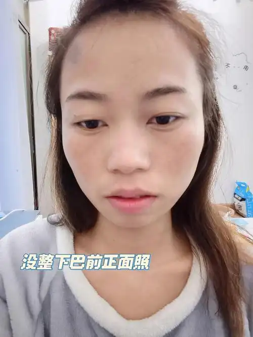 是龅牙还是短下巴