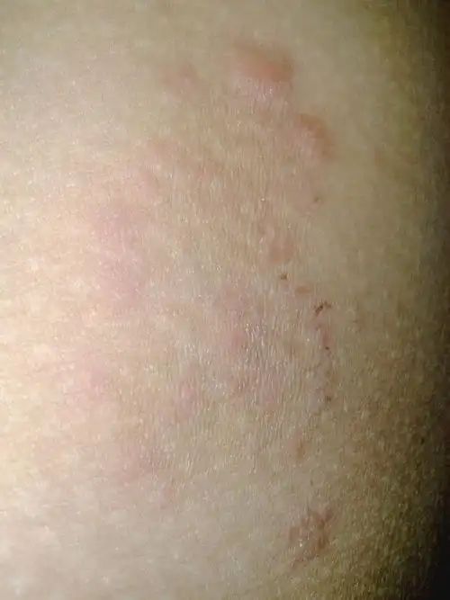 大腿内侧,皮肤病