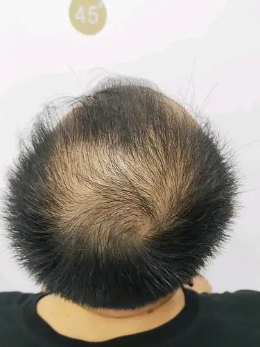 主任说我是m o类型的脱发,再晚里几年就是地中海了,我的天呐,二十三岁