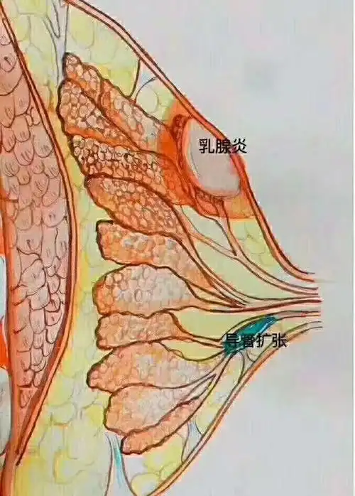 得了乳腺炎,可以继续哺乳吗!