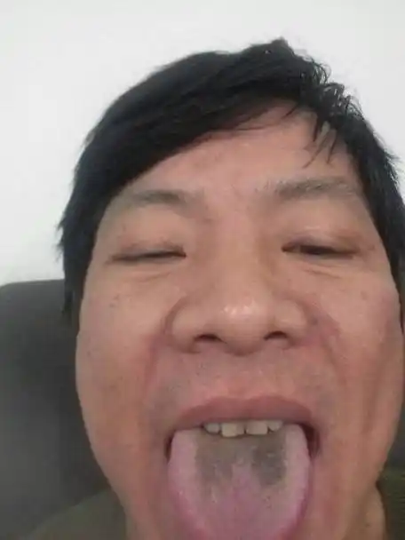 舌苔发黑为什么?