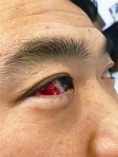 宁波男子盯着手机通宵追剧 结果眼睛出血 这个细节太要命