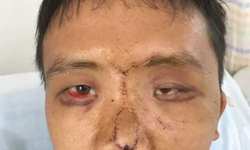 15,眼球内陷,眼球运动正常.