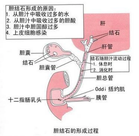 保胆手术的必要性
