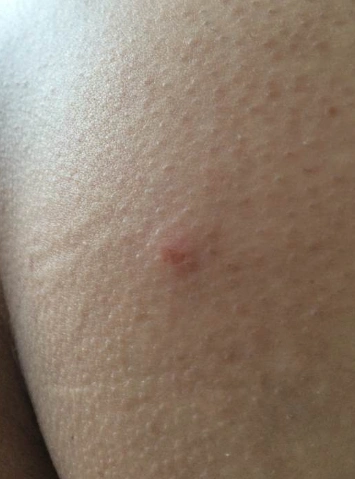 梅毒前期小红点图片 (13)