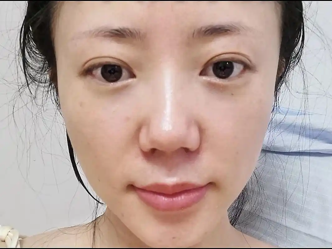 求美者面部肌肉松弛下垂,法令纹凹陷严重,皮肤暗沉无光泽,苹果肌下垂