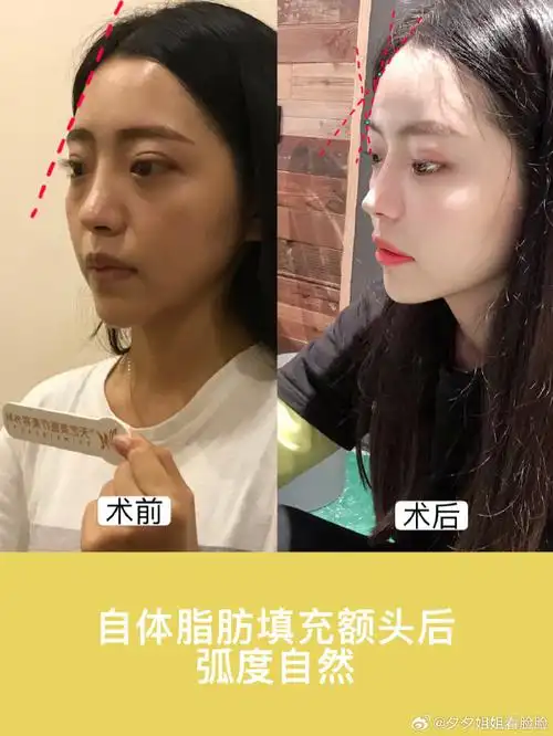 自体脂肪丰额头的正确打开方式!