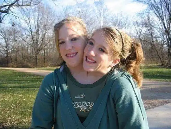 世界上真实存在的"双头人",姐妹共用一个身体,却爱上不同男人