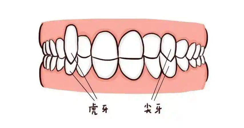造成恒尖牙没有空间萌出,就被推挤出去变成虎牙了
