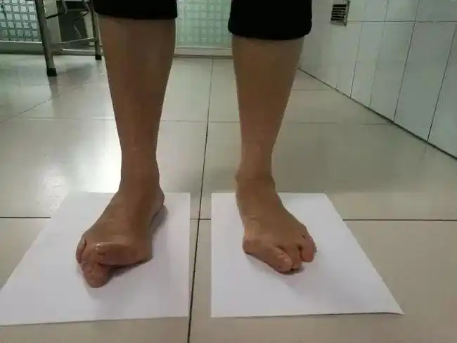 甚至与第二趾交叉,重叠,这在医学上称为"踇外翻",也就是俗称的"大脚骨