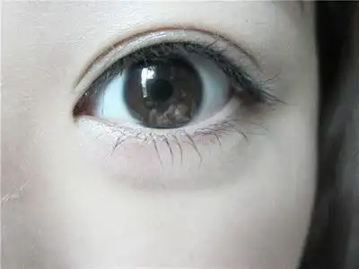 自体脂肪桃花眼整形手术价格一般多少钱?