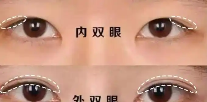 在大部分人的审美观念中,内双没有外双眼皮好看,认为外双眼皮才能够