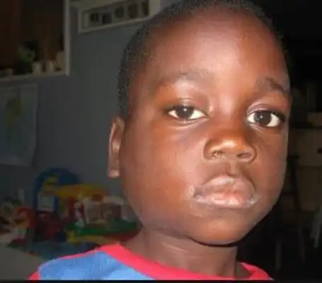 腮腺炎的症状和图片 (22)