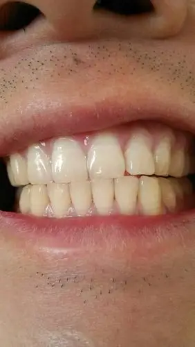 这牙齿是表面黄还是里面就不白呀?