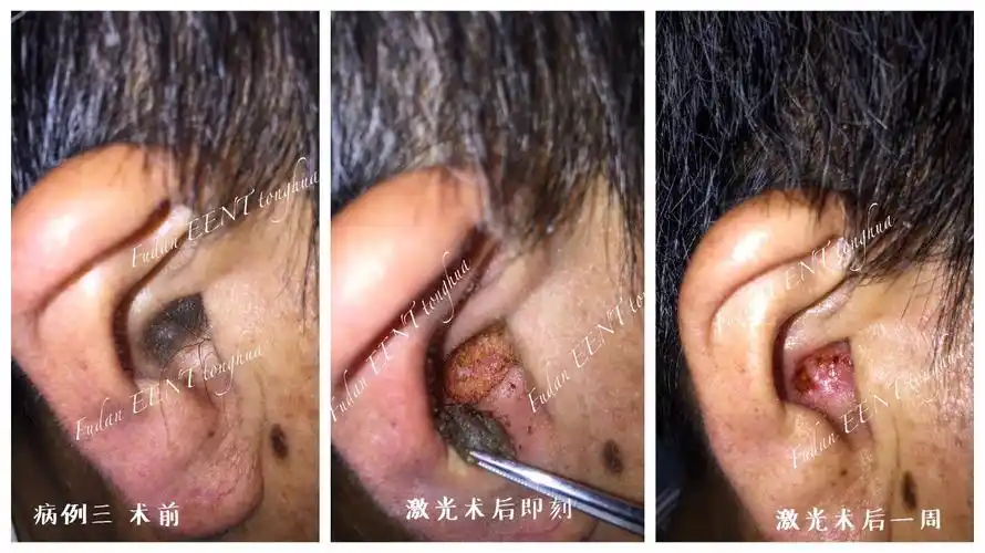 激光治疗耳廓脂溢性角化症 - 好大夫在线