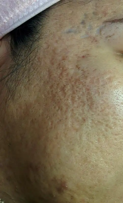 『医美分享』非常严重痘坑,还有得救吗?