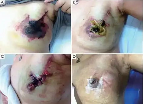 乳房整形手术:安全美容两不误 - 好大夫在线