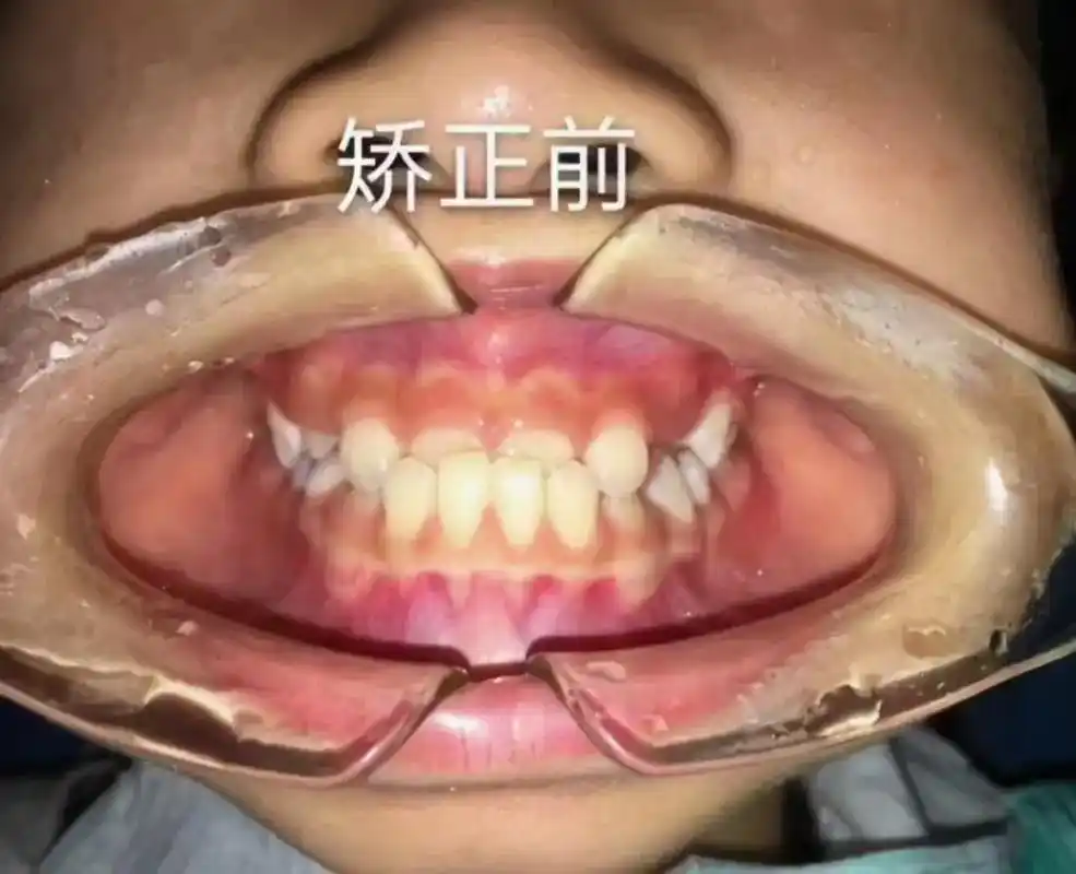 发现孩子地包天下牙包着上牙早发现早治疗效果显著黄金期是36岁哦