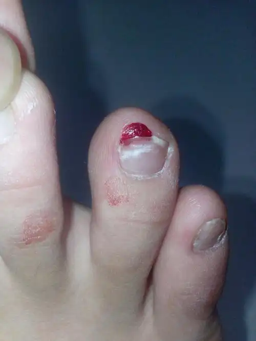 不小心把脚趾甲撞到桌子上了,好像中间折了,但没断,当时还流了血,该