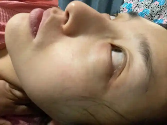 液氮冷冻  #雀斑冷冻祛斑马上一年了,目前的话还是有黑点,主要是未档