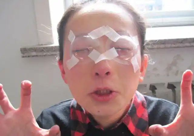 曾用激光手术治近视眼的人如今眼睛怎么样了会不会有后遗症