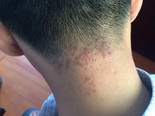 颈部皮疹 - 皮肤及性传播疾病讨论版 - 爱爱医医学论坛