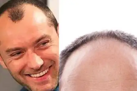 【图】发际线后移怎么办 一招解决你的疑惑