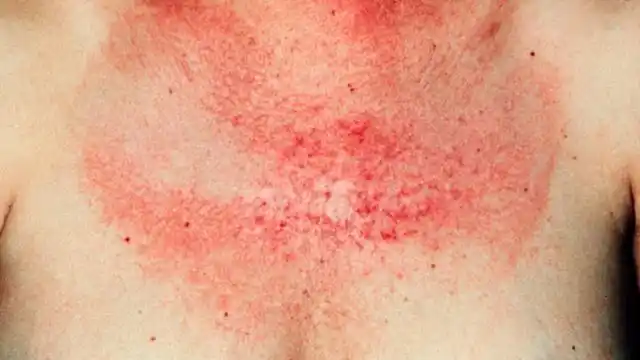 皮疹约5%的白血病患者皮肤出现皮疹,可分为两类:一类是皮肤上有凸起