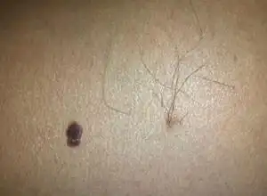 黑痣,黑痣的原因,黑痣怎么办-皮肤性病科-皮肤科-症状查询-寻医问药