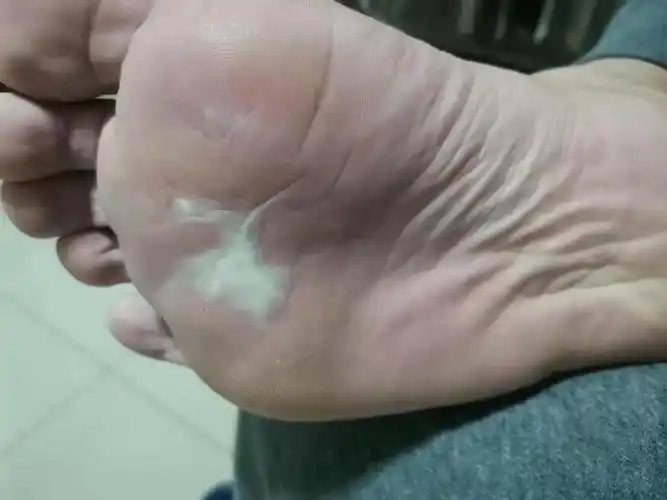 脚底有一块地方泛白,不痛不痒,表皮完整,请问这是咋地了?