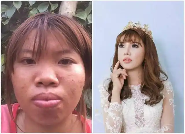 女子长得太丑被丈夫抛弃怒砸10万元整容后从丑女变女神