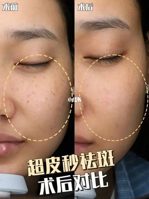 超皮秒祛斑治疗对比