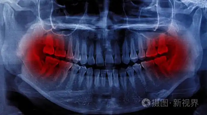 人类牙齿的x线扫描