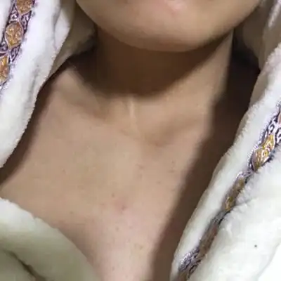 怀孕过后额头上和胸部就长了这样的,有的朋友说生完