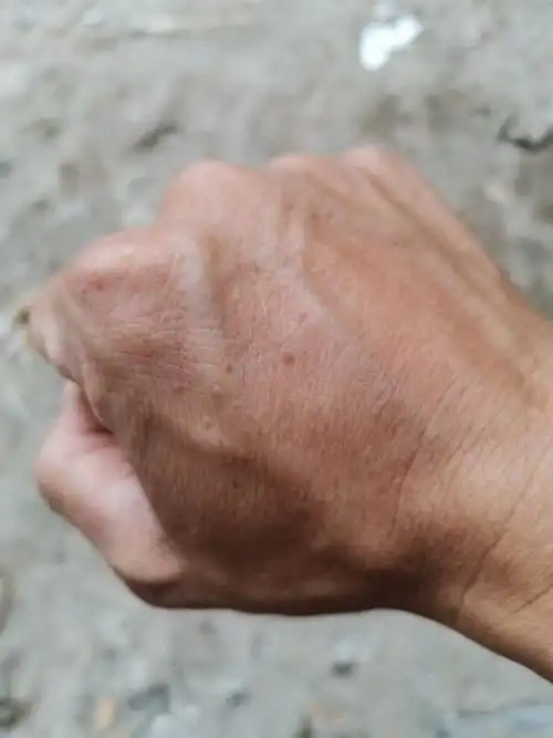 我手背上长的是老人斑吗?今年33岁,有高血压病史.