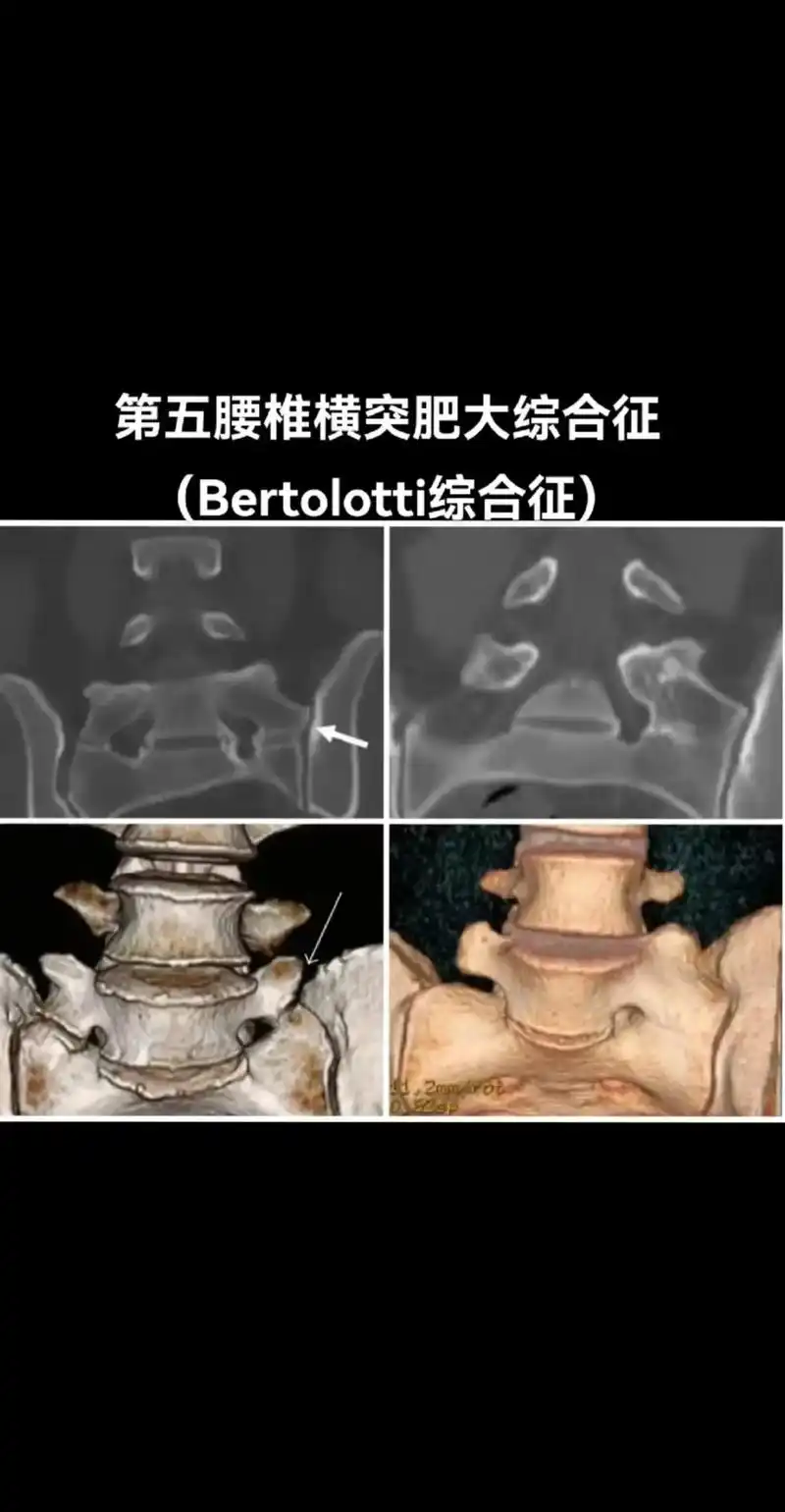 医学影像 第五腰椎横突肥大综合征(bertolotti综合 - 抖音