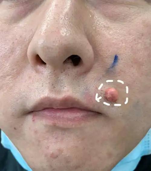 皮肤恶性肿瘤_基底细胞癌_基底细胞癌症状表现 - 好大夫在线