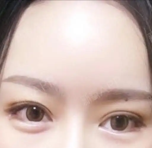 【双眼皮 开外眼角】术后59天