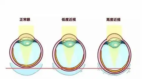 户外运动在近视防控中有用?视百年眼科给出这样的回复